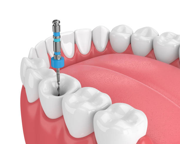 Endodoncia