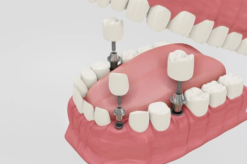 implantologia-oral